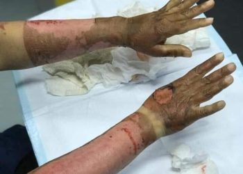 Санитолоор гараа ариутгаад түлэгдсэн эмэгтэй