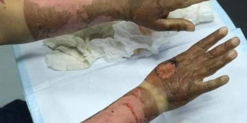 Санитолоор гараа ариутгаад түлэгдсэн эмэгтэй