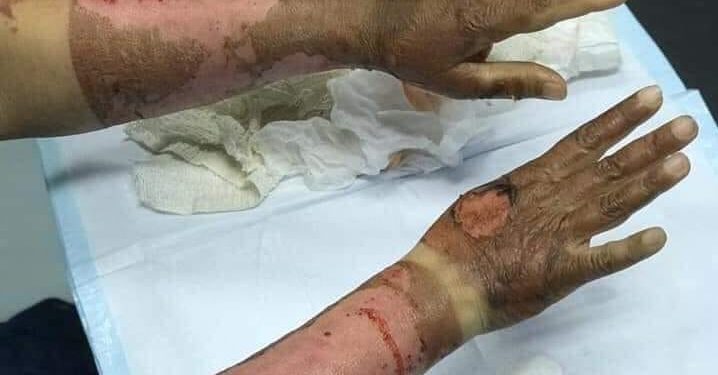 Санитолоор гараа ариутгаад түлэгдсэн эмэгтэй