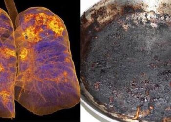 Хэт хүнд туссан хүмүүсийн уушгийг эдгэснийх нь дараа рентгенээр харахад түлэгдээд, дагтаршсан хайруулын тавагтай төстэй байсан хэмээв