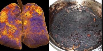 Хэт хүнд туссан хүмүүсийн уушгийг эдгэснийх нь дараа рентгенээр харахад түлэгдээд, дагтаршсан хайруулын тавагтай төстэй байсан хэмээв