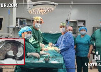 Зургаан настай хүүхдийн ходоодноос дөрвөн жил идэж, бөөгнөрүүлсөн үсийг авлаа