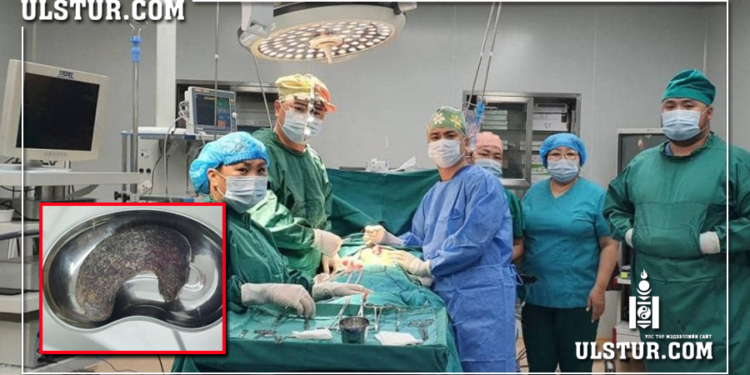 Зургаан настай хүүхдийн ходоодноос дөрвөн жил идэж, бөөгнөрүүлсөн үсийг авлаа