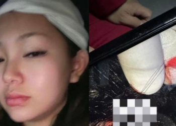 Инстаграмын инфлүүнсэрийг гэмтээсэн эмэгтэй СЭМҮТ-ийн өвчтөн байжээ