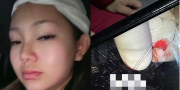 Инстаграмын инфлүүнсэрийг гэмтээсэн эмэгтэй СЭМҮТ-ийн өвчтөн байжээ