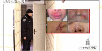 Хамар өндөрлөх филлер тарилга хийхдээ үйлчлүүлэгчийнхээ эрүүл мэндэд нь ноцтой хохирол учруулжээ