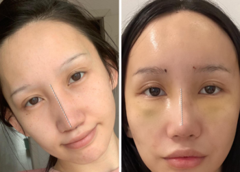 Баярмаа: Миний хүссэн хамрын хэлбэр өнөөдөр биеллээ оллоо