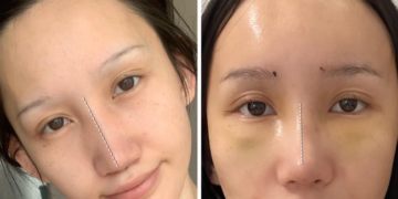 Баярмаа: Миний хүссэн хамрын хэлбэр өнөөдөр биеллээ оллоо