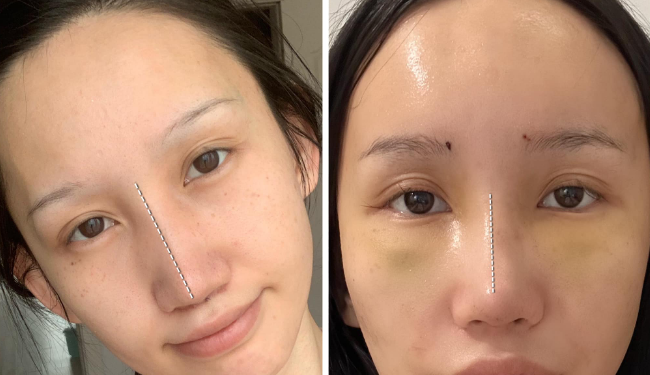 Баярмаа: Миний хүссэн хамрын хэлбэр өнөөдөр биеллээ оллоо